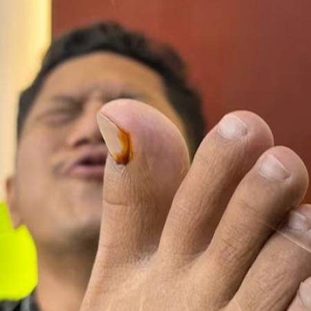 Apa Itu Cantengan? Penyebab, Gejala, dan Cara Mengatasinya